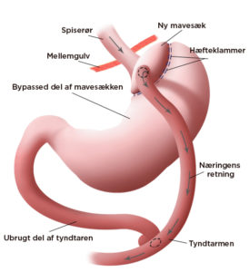 Gastrisk bypass reducerer medicinforbrug med 40-70 procent