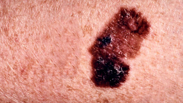 Dermatologer laver otte episkopier dagligt