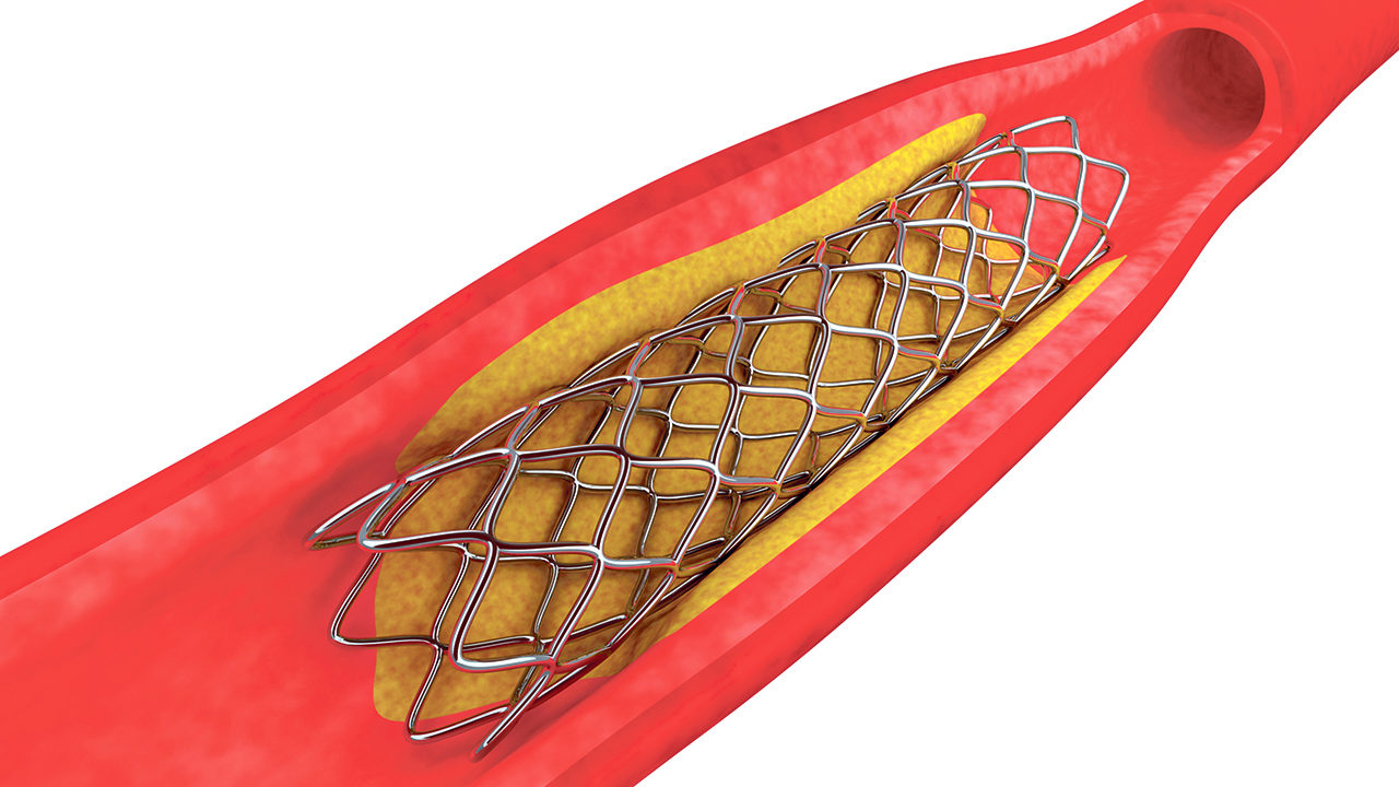 Patienter bør inddrages i valg mellem hjerteoperation eller stent